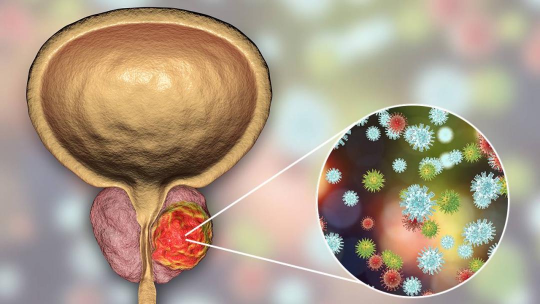  Conocer el  cáncer de próstata es necesario  ¡Visita al urólogo!