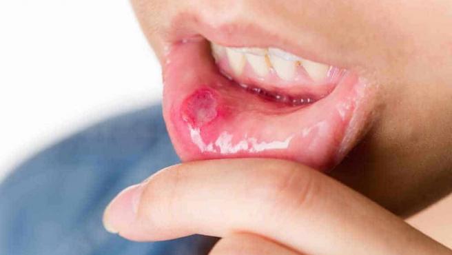 ¿Qué es el herpes simple? Estos son sus síntomas, sus causas y su tratamiento